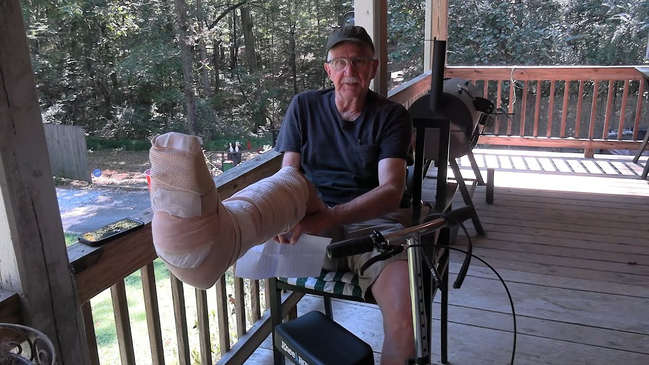 I Broke my Leg!